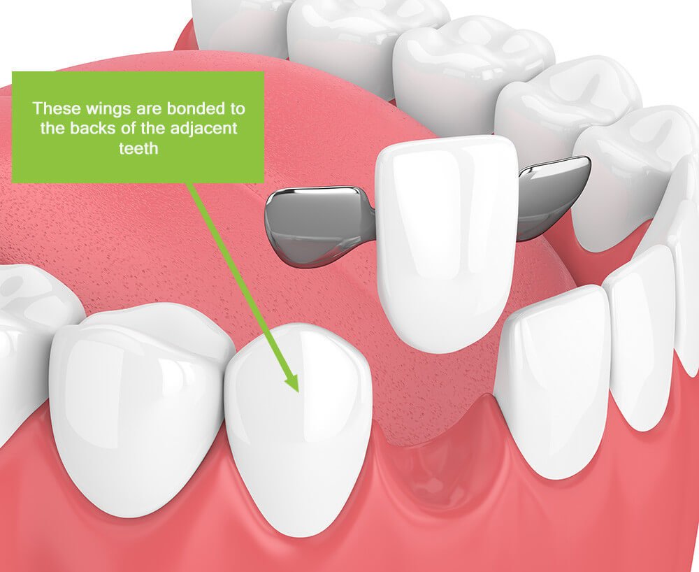 Fixed Dental Bridge